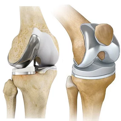 Antalya Knee Replacement Surgery
