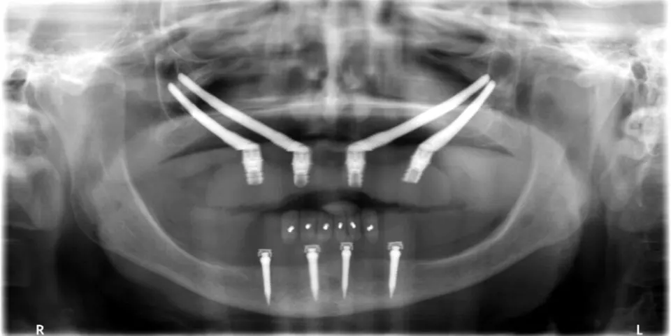 Straumann PURE ceramic zirconia implant — metal-free option