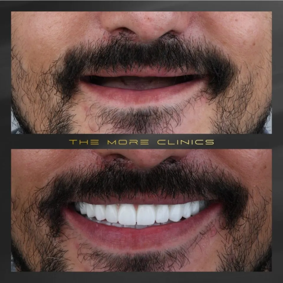 Full mouth missing teeth replaced — All-on-4 Turkey before after