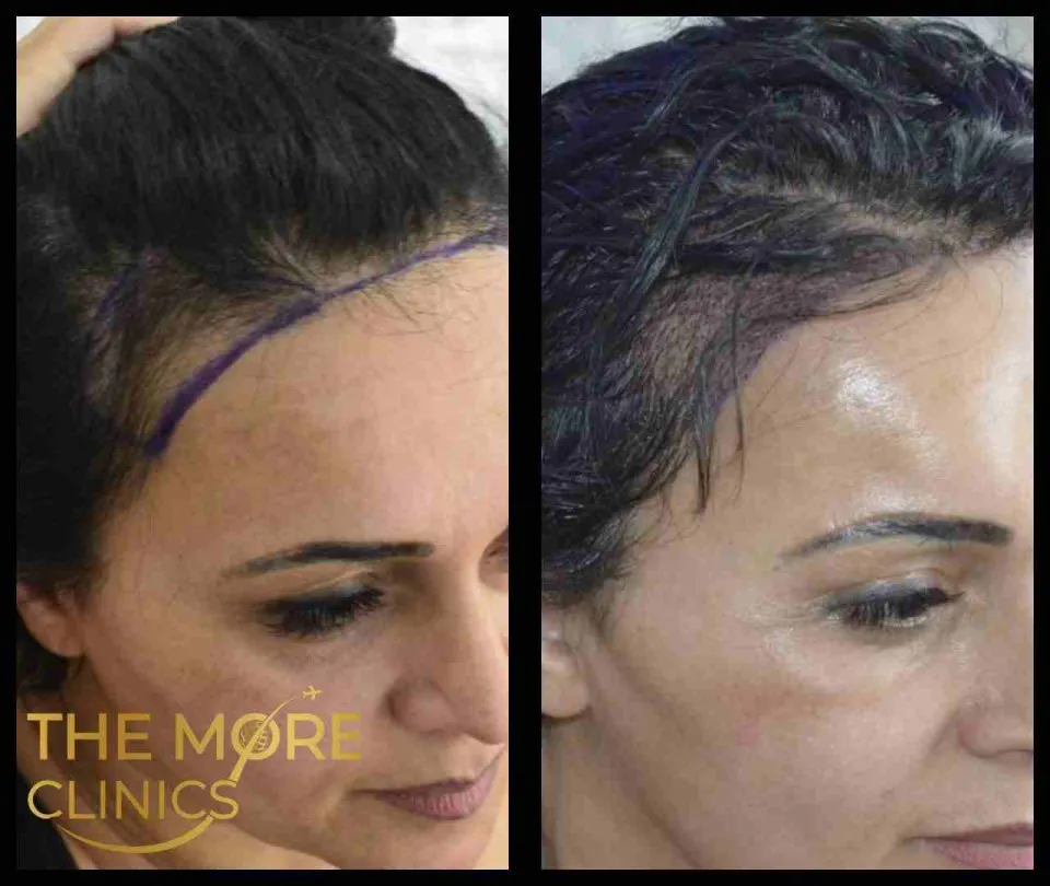 haartransplantation frauen vorher nachher