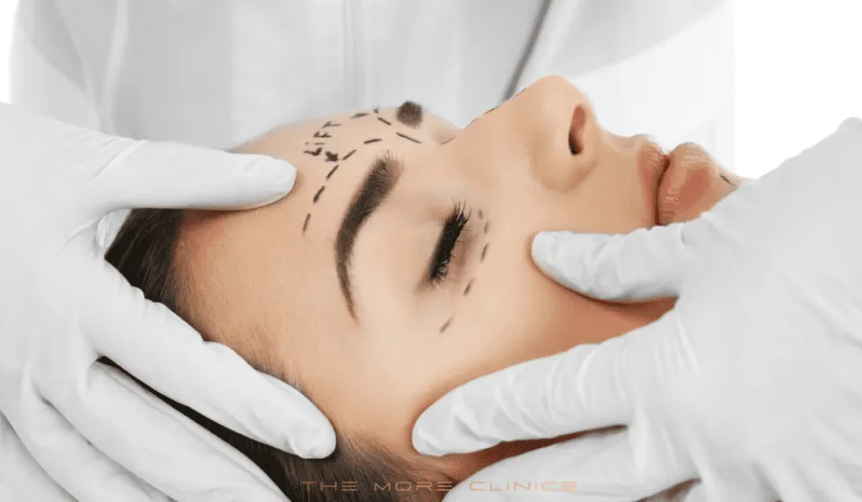 Botox before and after brow lift result