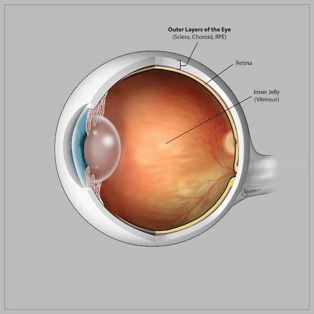 a detached retina