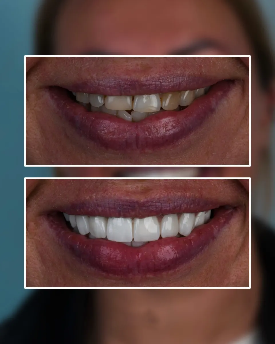 Smile makeover with dental implants Turkey Antalya before after