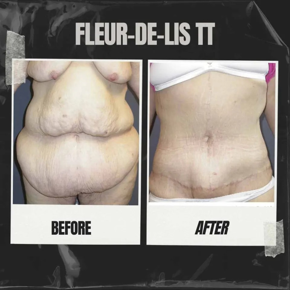 fleur de lis tummy tuck before and after