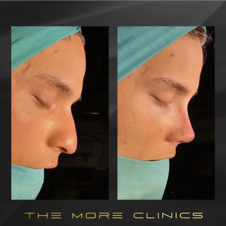Rhinoplasty at 30, 40 or 50: Best Age for a Nose Job (2026 Guide)