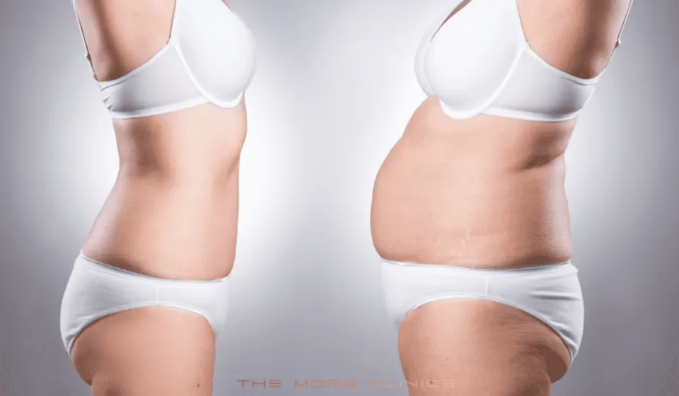woman happy with liposuction before and after result