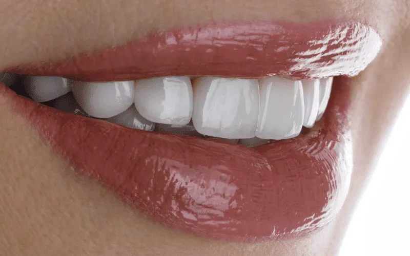 Antalya composite veneers