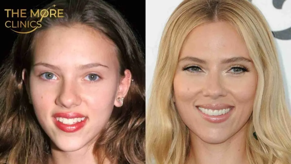 Scarlett Johnson Celebrity Veneers Before After