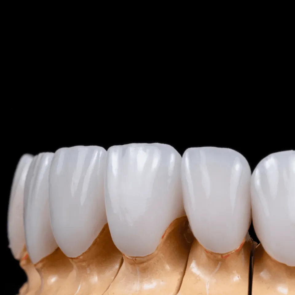 Implante dental en Antalya