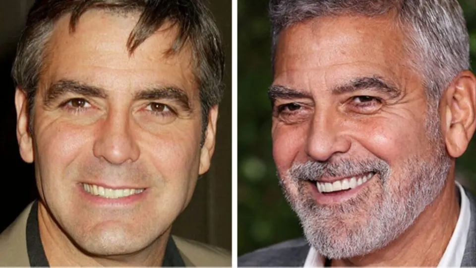celebrity veneers before and after george clooney