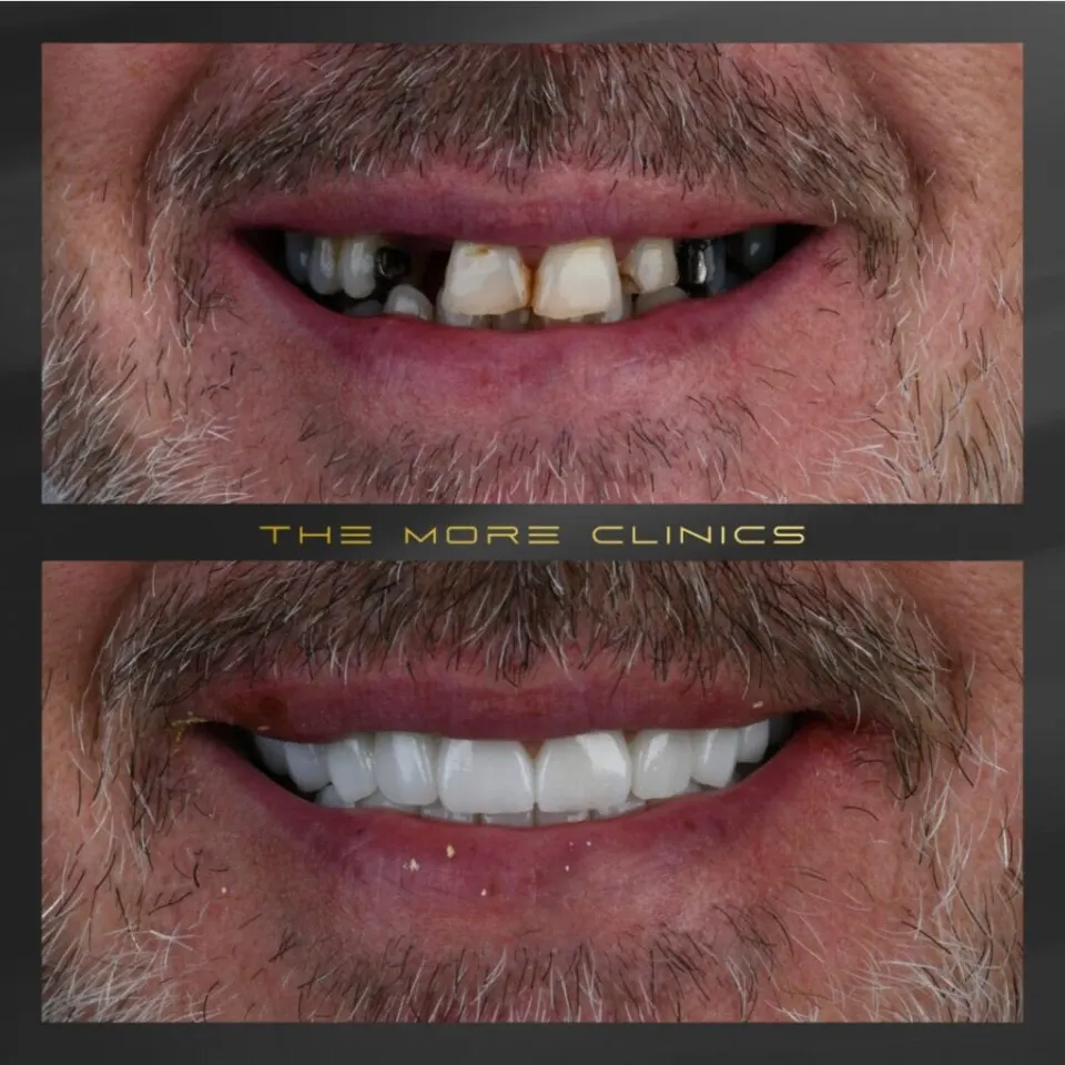Front tooth crown before and after — E-Max ceramic crown