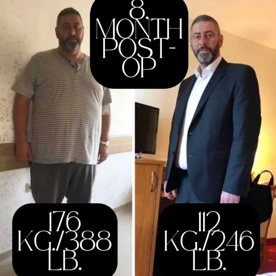 gastric sleeve before and after
