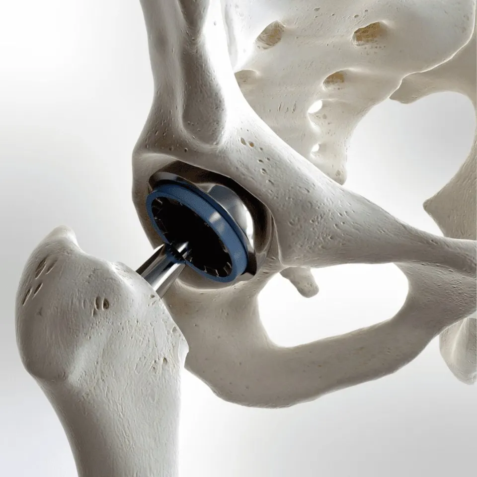 Antalya Hip Replacement Surgery