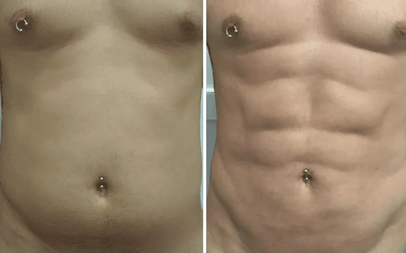 6 pack surgery before and after