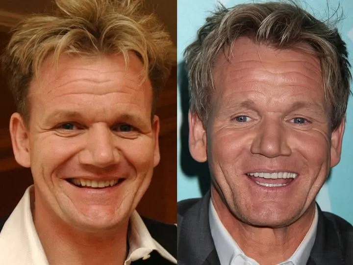 Gordon Ramsay Teeth Celebrity Veneers