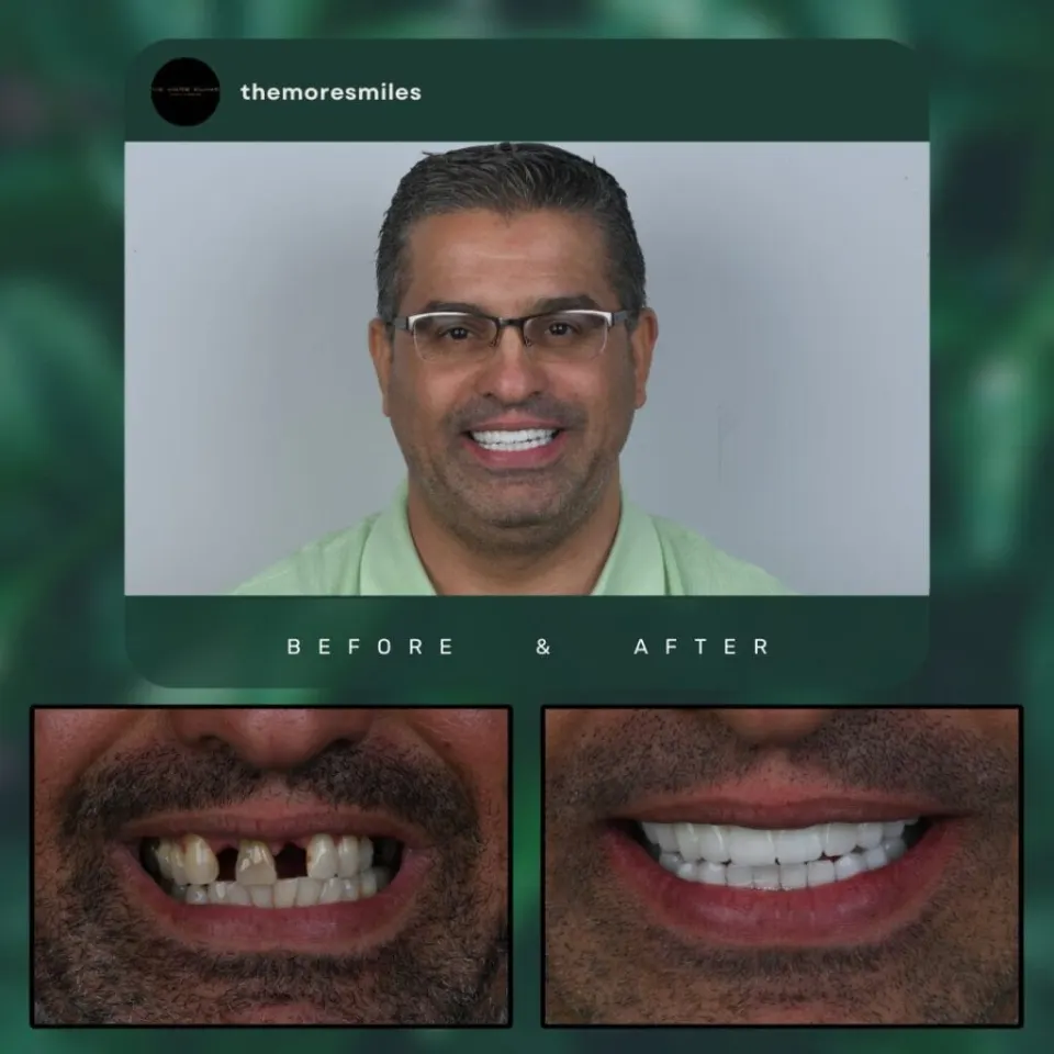 Dental results 3