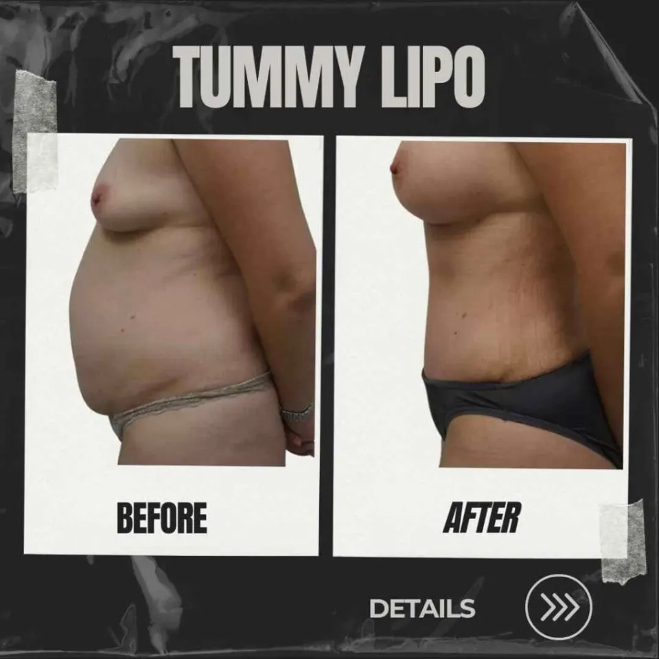 tummy liposuction before and after