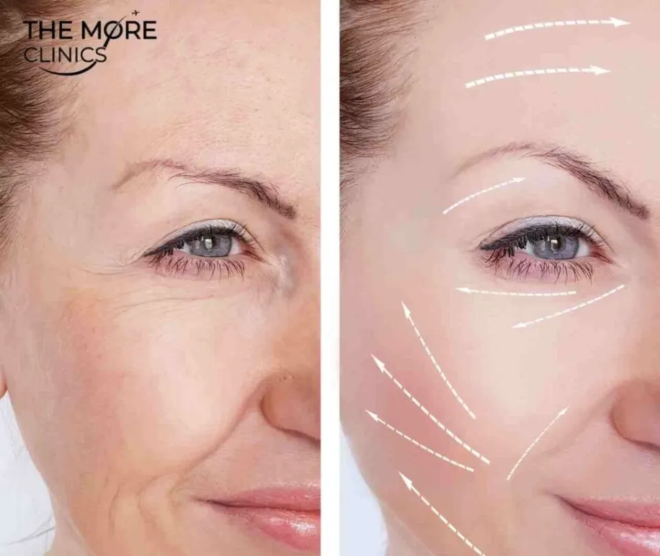 vertical restore before and after facelift turkey