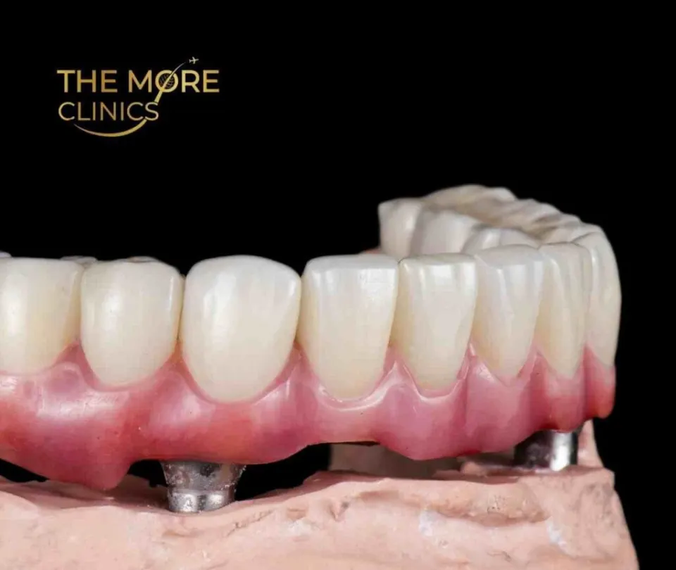 Türkiye'de all on four diş implantının avantajları