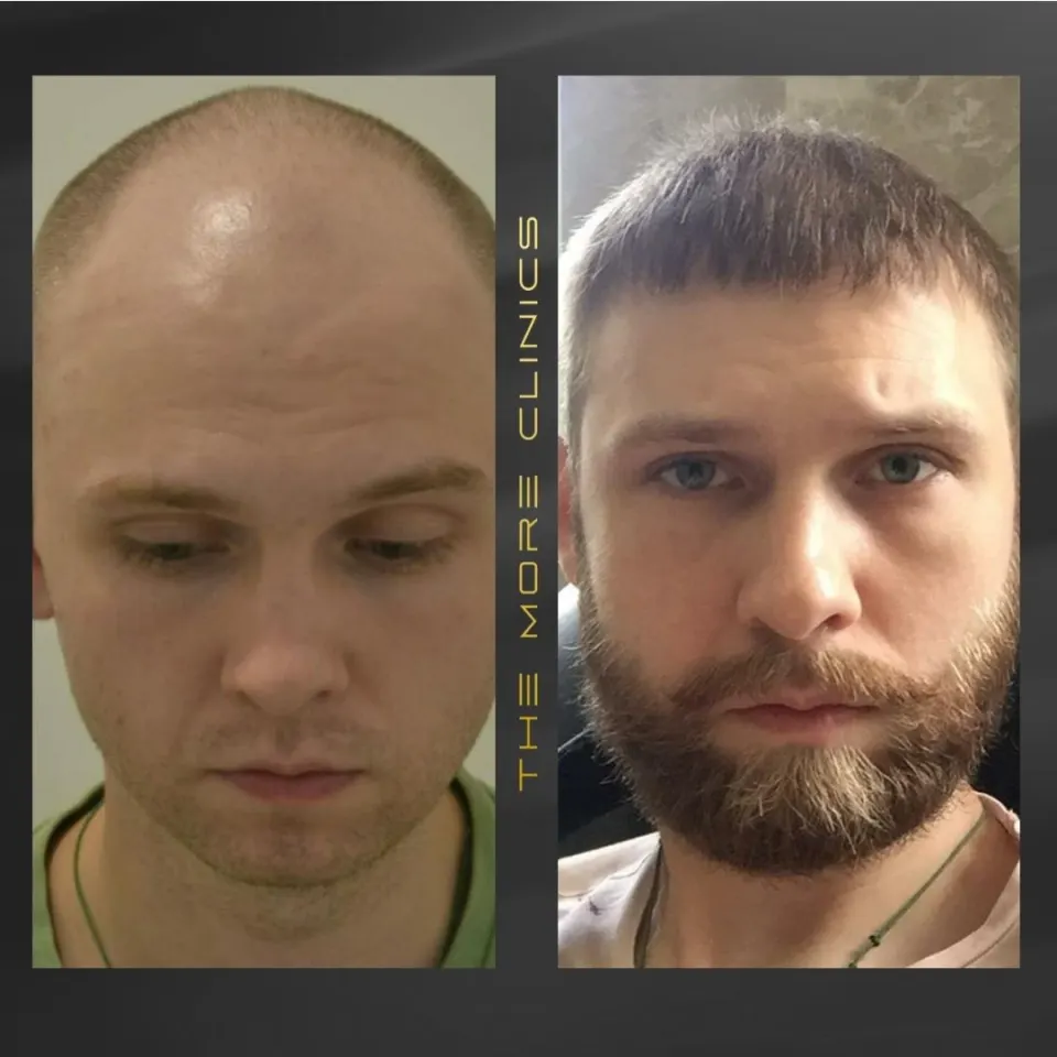 Haartransplantation in Antalya, Türkei, vorher und nachher