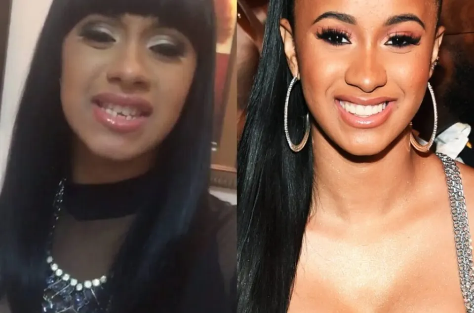 Cardi B Teeth Before and After