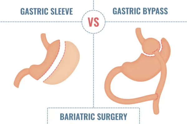 Gastric Bypass vs Sleeve Gastrectomy: Which Is Better for YOU? 2026
