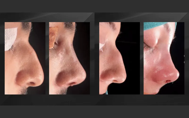 Antalya rinoplastia septoplastia de pavo antes y después