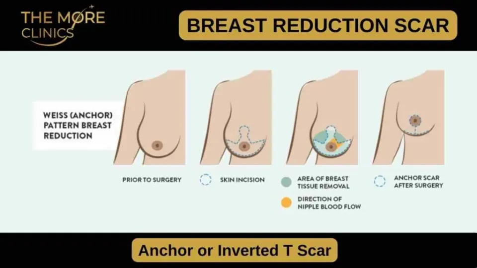surgery scar anchor shaped