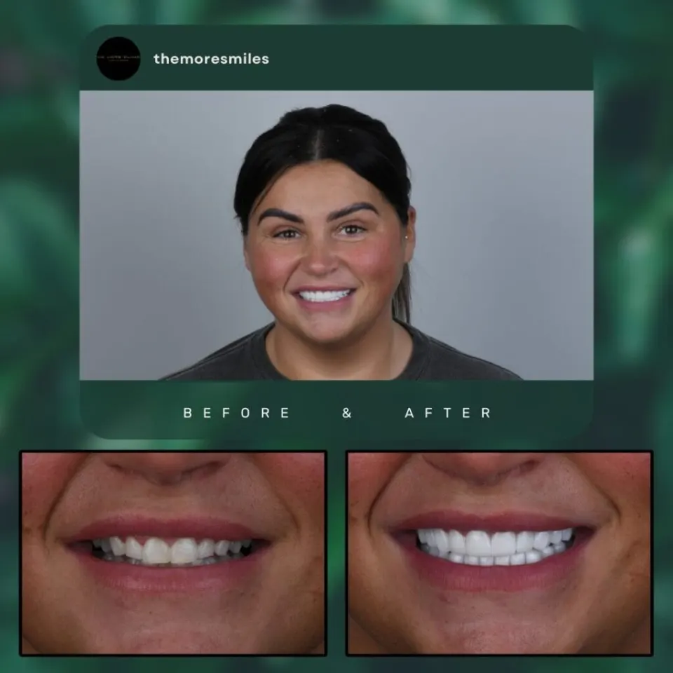 Veneers Vorher Nachher Türkei Antalya — E-Max Laminate Veneers