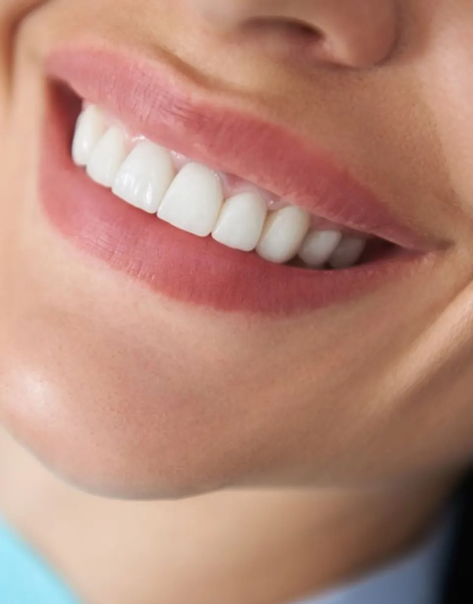 Antalya Dental Veneers