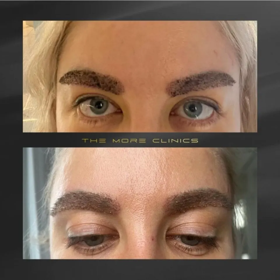 transplante de cejas antes después resultado