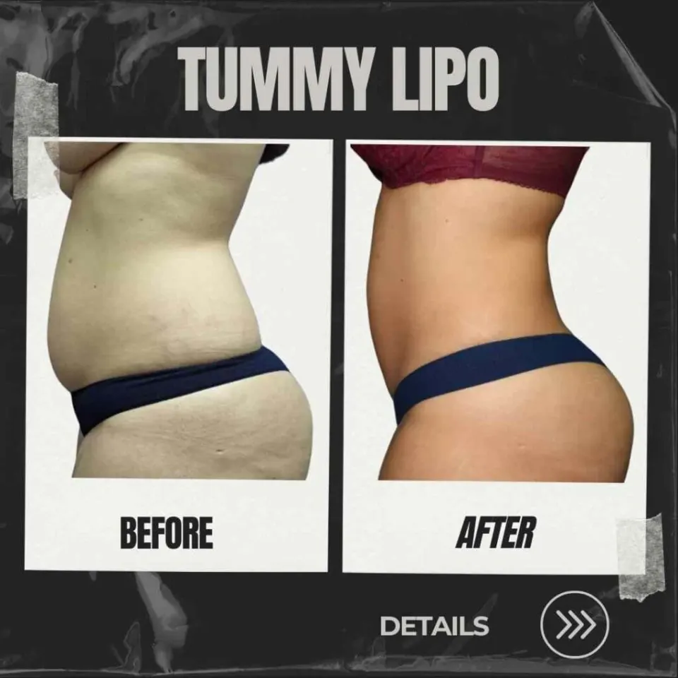 liposuction before and after