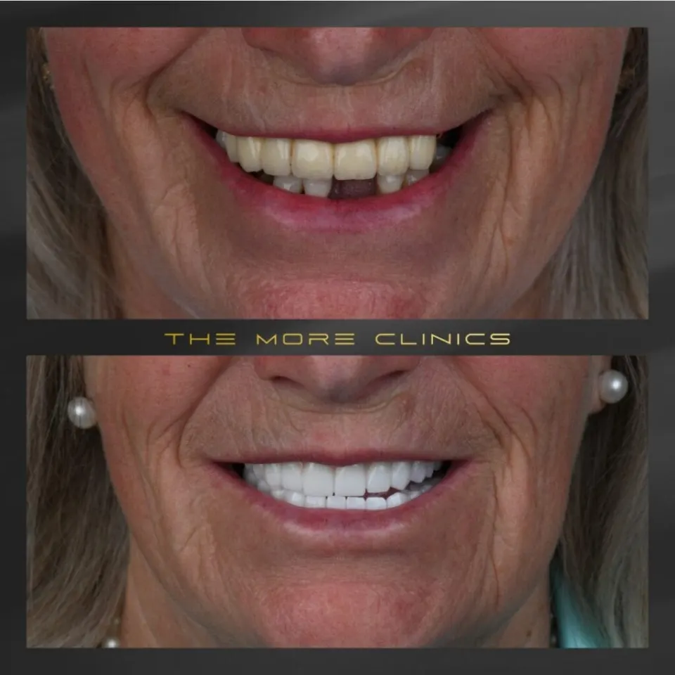 Dental results 6