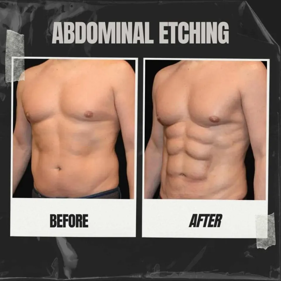abdominal etching before after information purpose