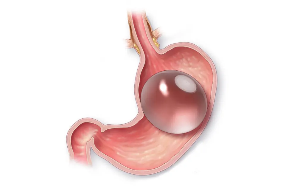 endoscopic gastric balloon