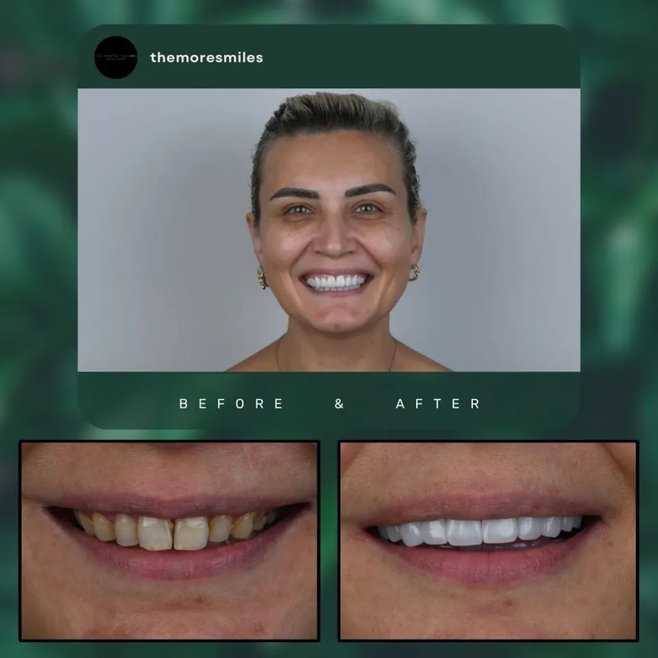Laminate veneers before after Antalya Turkey