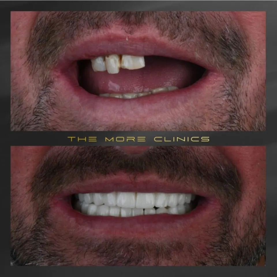 Dental crowns before and after — zirconia crown result Turkey