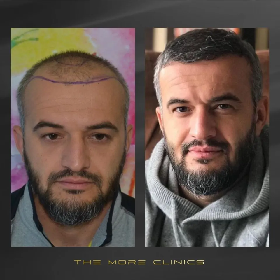 haartransplantation antalya vorher nachher