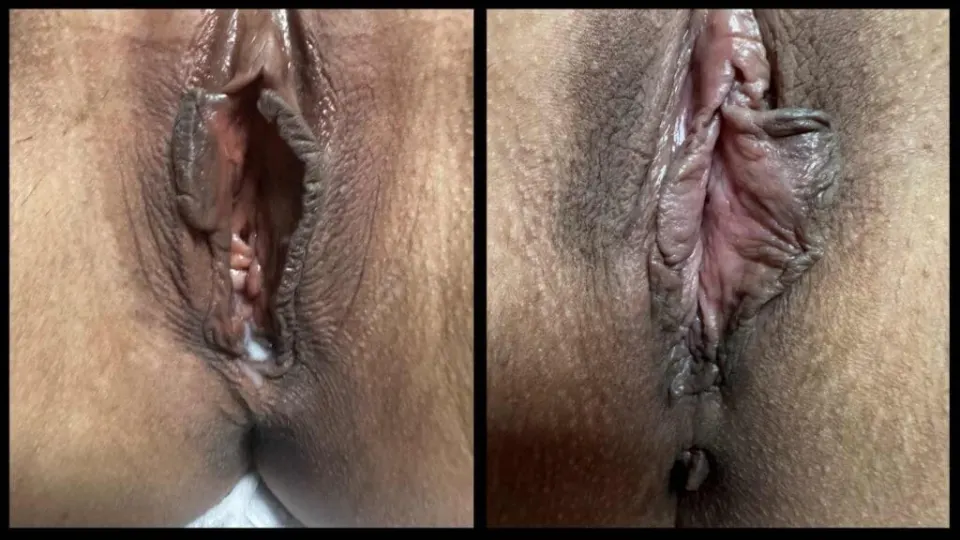 botched vaginoplasty before afters