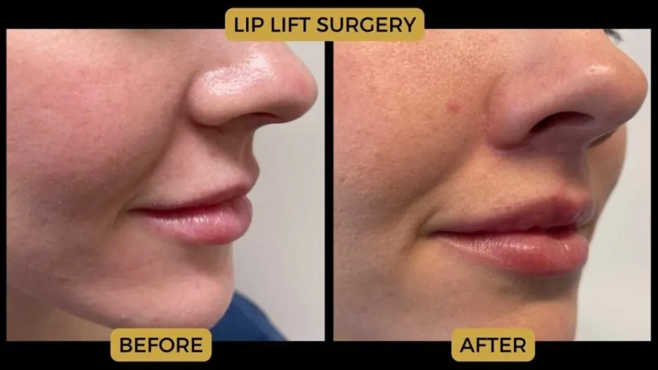 lip lift surgery turkey before and after