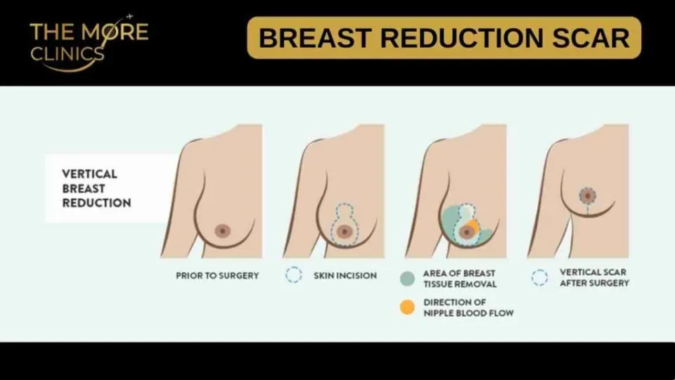 what do breast reduction scars look like (vertical pattern)
