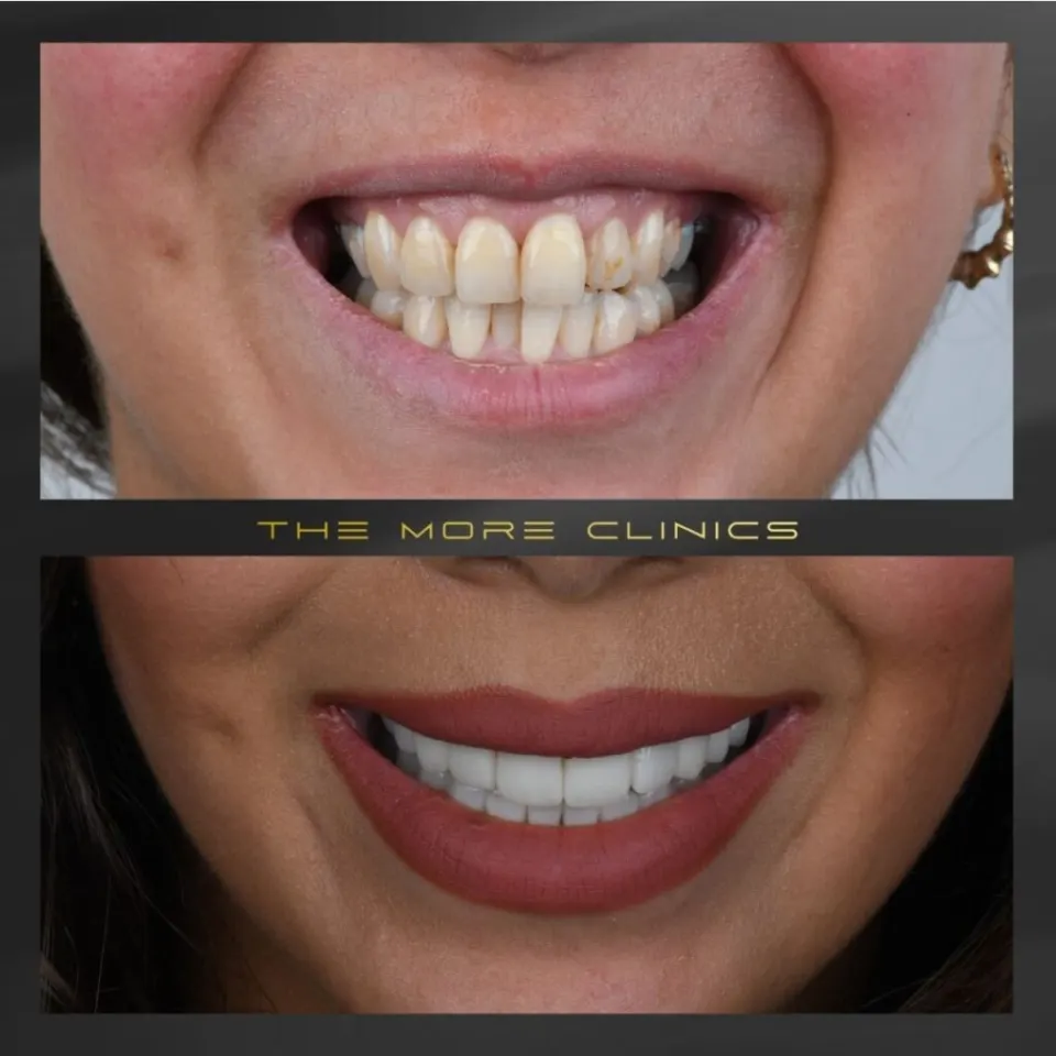 turkey teeth zirconium dental crowns