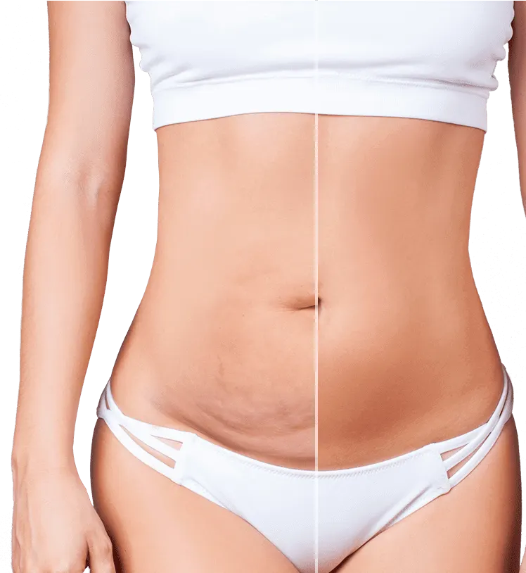 tummy tuck Antalya Turkey