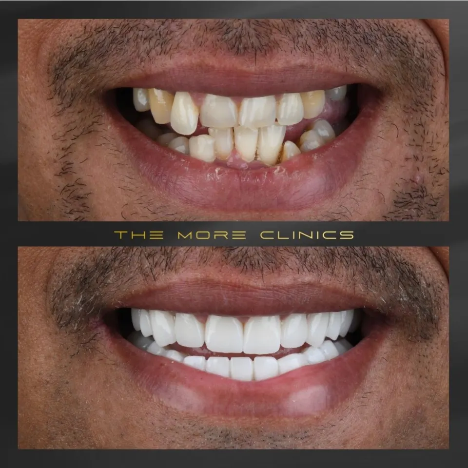 Veneers bei schiefen Zähnen vorher und nachher