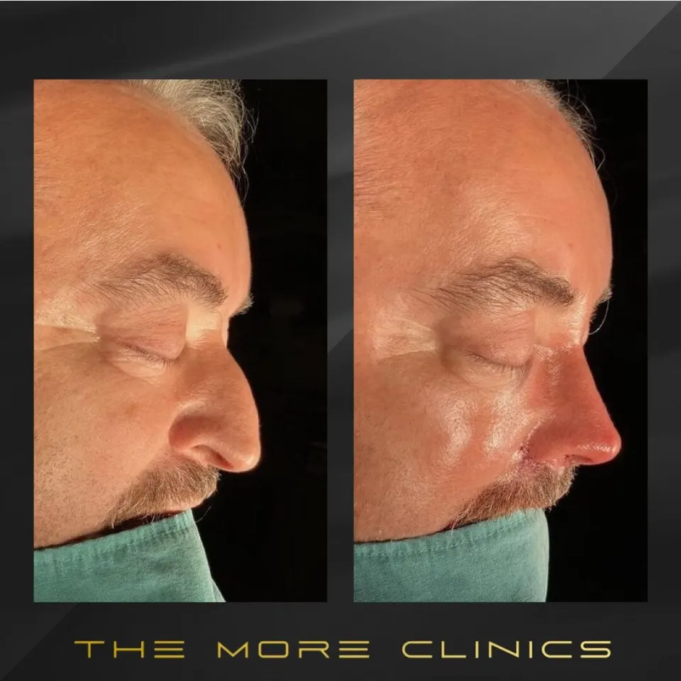 men's rhinoplasty before and after male
