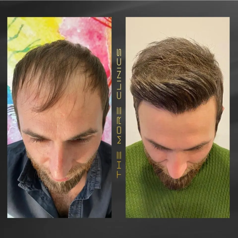 Hair-transplant results 4