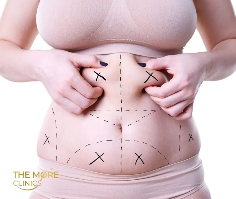 ideal candidate for turkey mommy makeover surgery