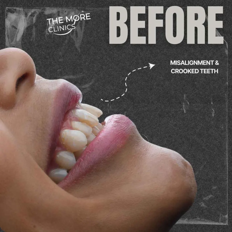 türkei komposit veneers kosten 