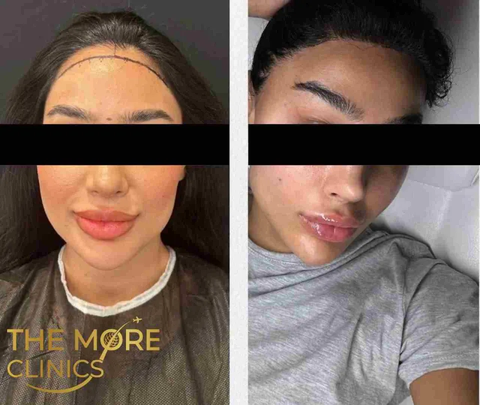 haartransplantation frauen vorher nachher
