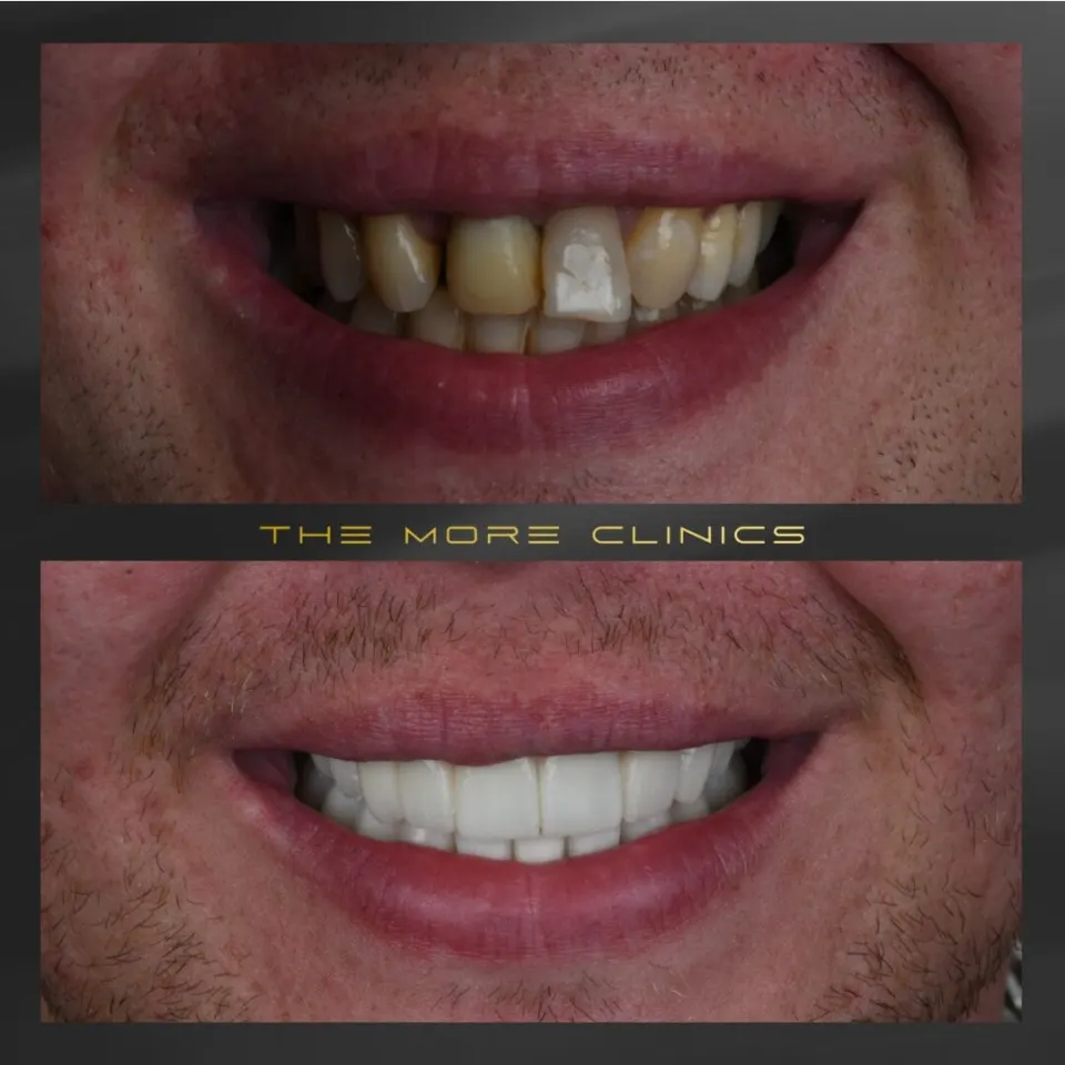 vorher nachher veneers schiefe zähne​
